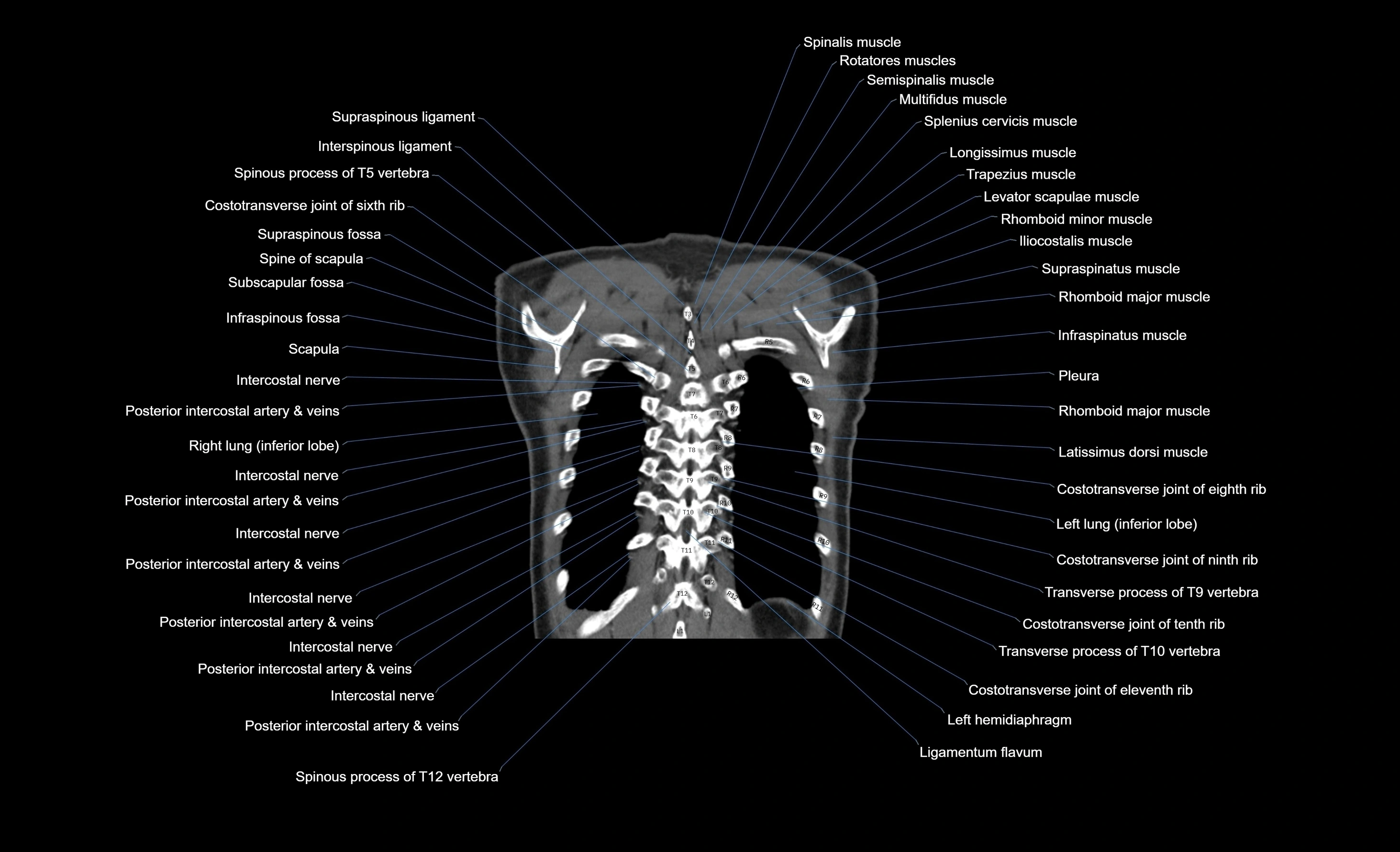 CT chest (thorax) labelled coronal cross sectional anatomy radiology image-00019.webp